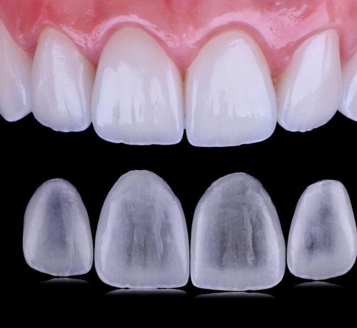 Porcelain Veneers