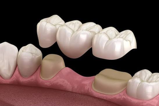 Dental Bridge